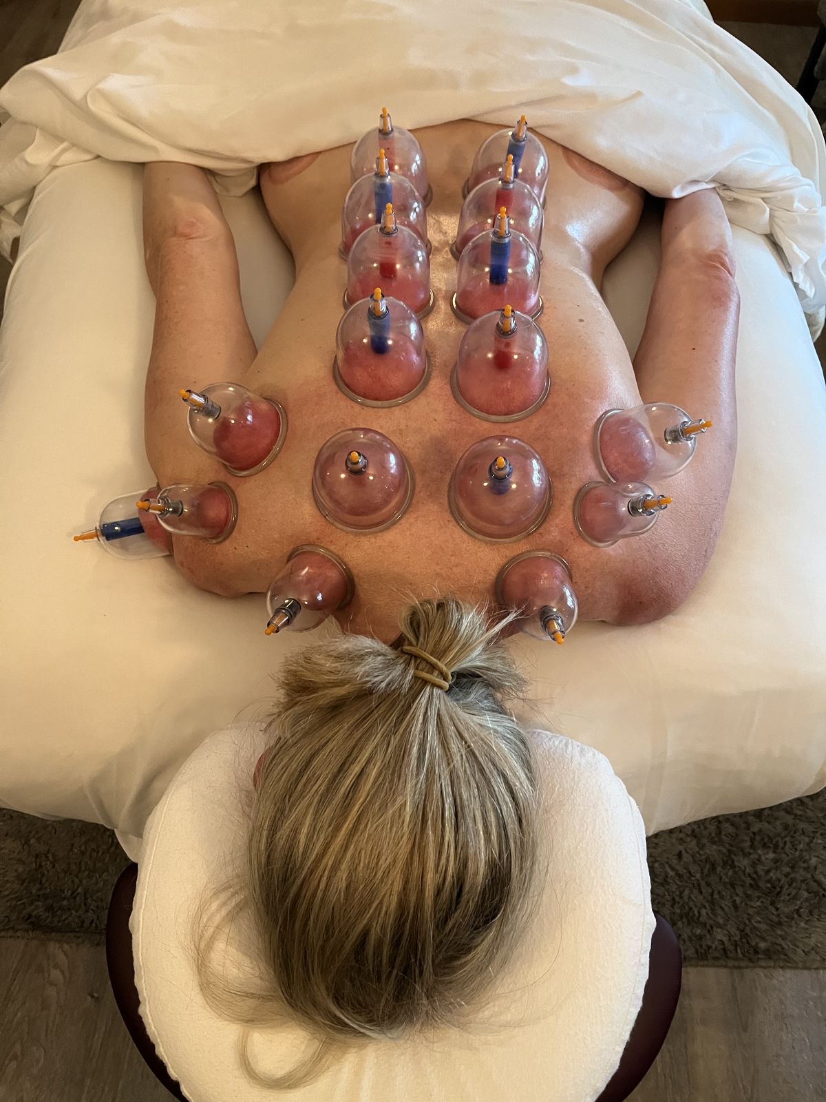 Cupping bekam therapy